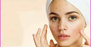 ✨ اسید سالیسیلیک؛ نجات‌دهنده‌ی پوست‌های مستعد جوش